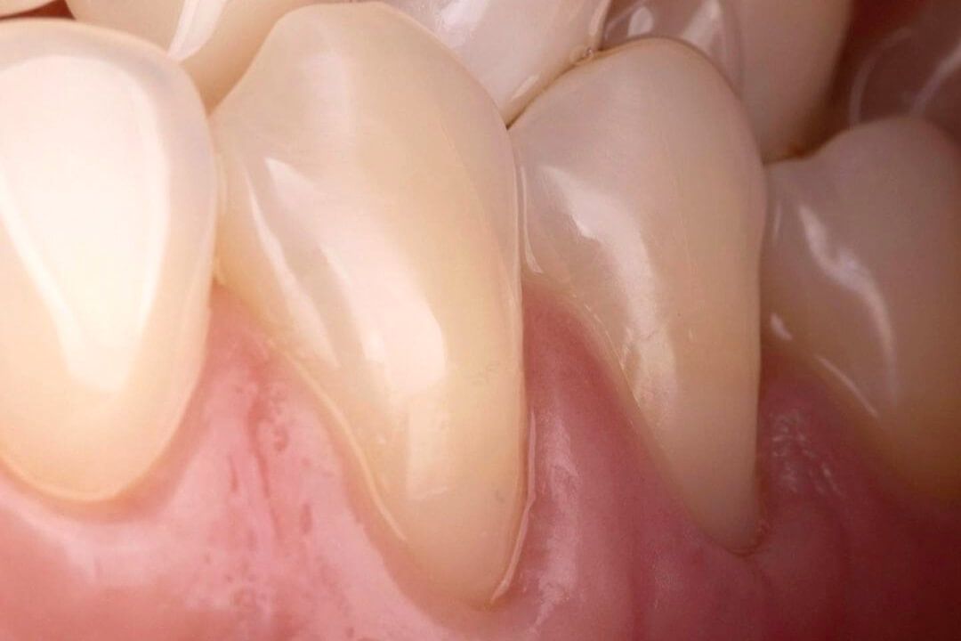 после лечения множественного клиновидного дефекта в стоматологии ТоталСтом