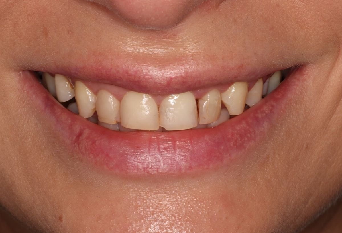 дефекты зубов зоны улыбки