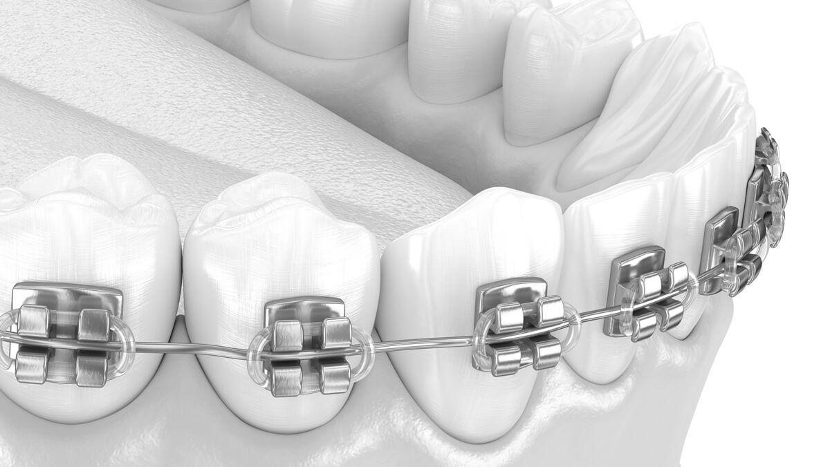 металлические брекеты в стоматологии ТоталСтом