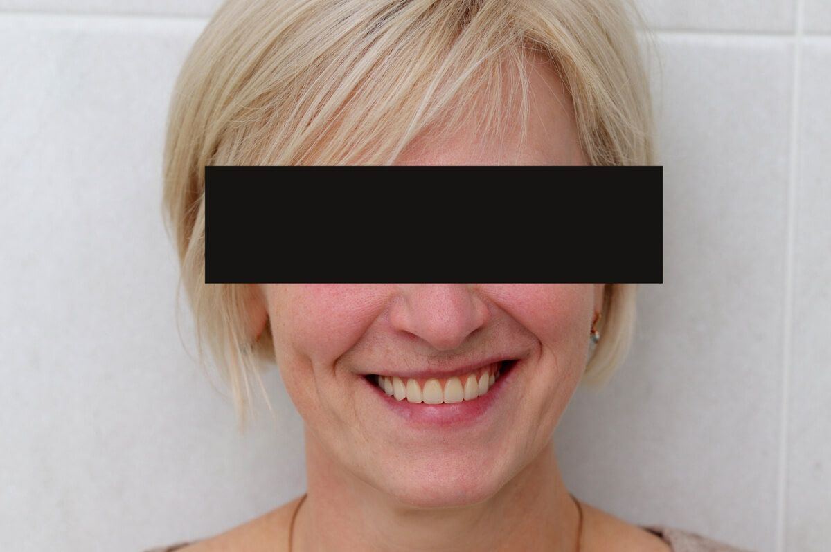 фото пациента после реабилитации верхней челюсти на 6 имплантатах