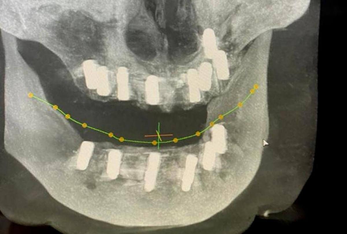 Компьютерная томограмма челюстей с установленными трабекулярными имплантатами Zimmer