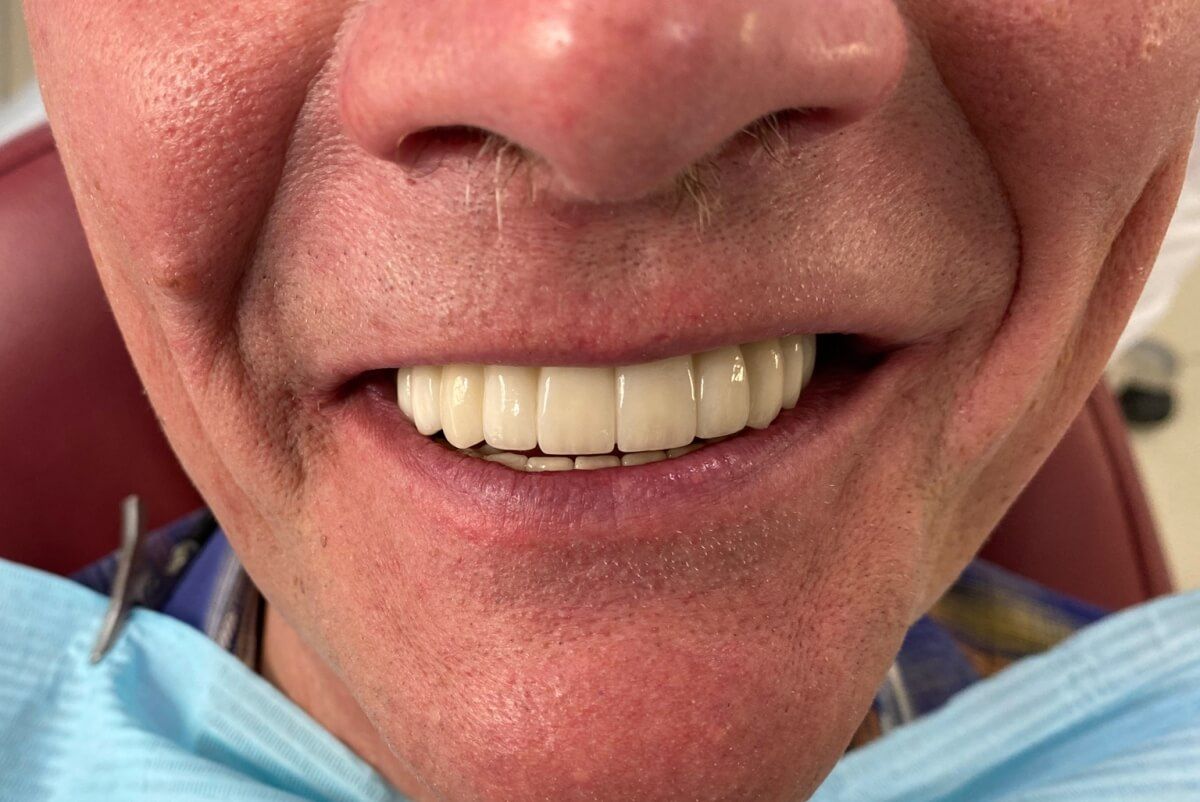 Лицо пациента после восстановления обоих челюстей на имплантатах Zimmer