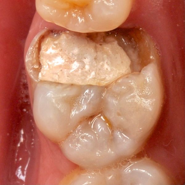 жевательный зуб требующий лечения каналов
