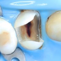 механическая обработка каналов зуба в стоматологии ТоталСтом