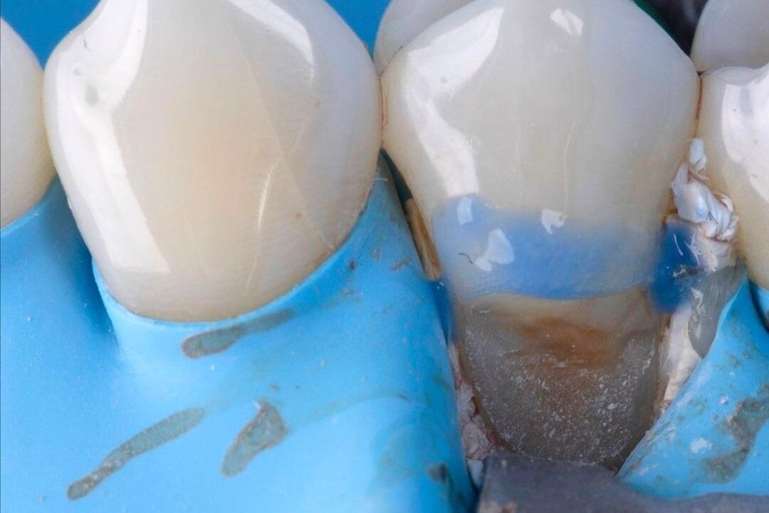 лечение клиновидного дефекта в стоматологии ТоталСтом