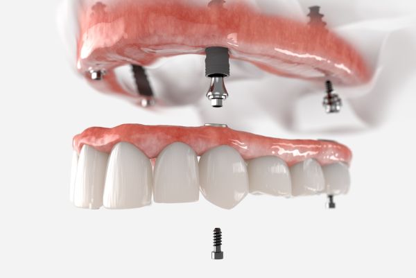 Восстановление зубного ряда на имплантатах