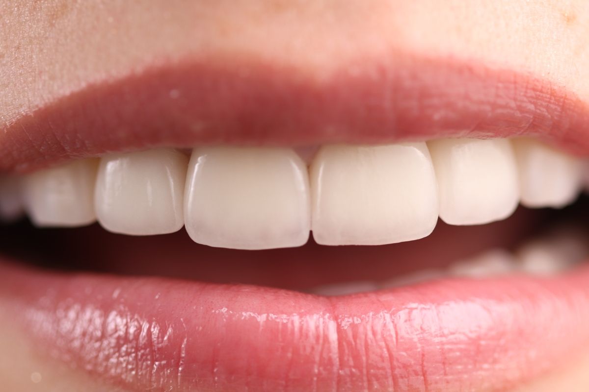 виниры на зубы в стоматологии ТоталСтом