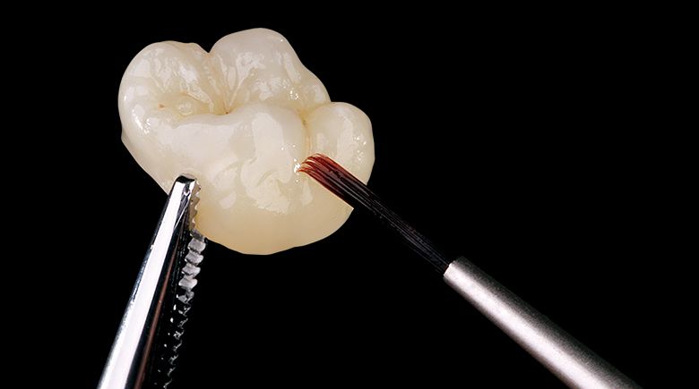 протезирование одного зуба коронкой из диоксида циркония в клинике ТоталСтом