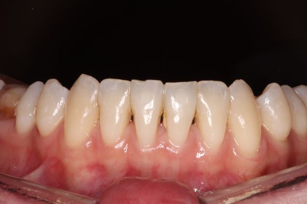 снимок зубов после эстетической реставрации зубов в стоматологии ТоталСтом