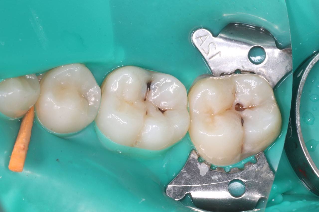 кариес до лечения на жевательном зубе
