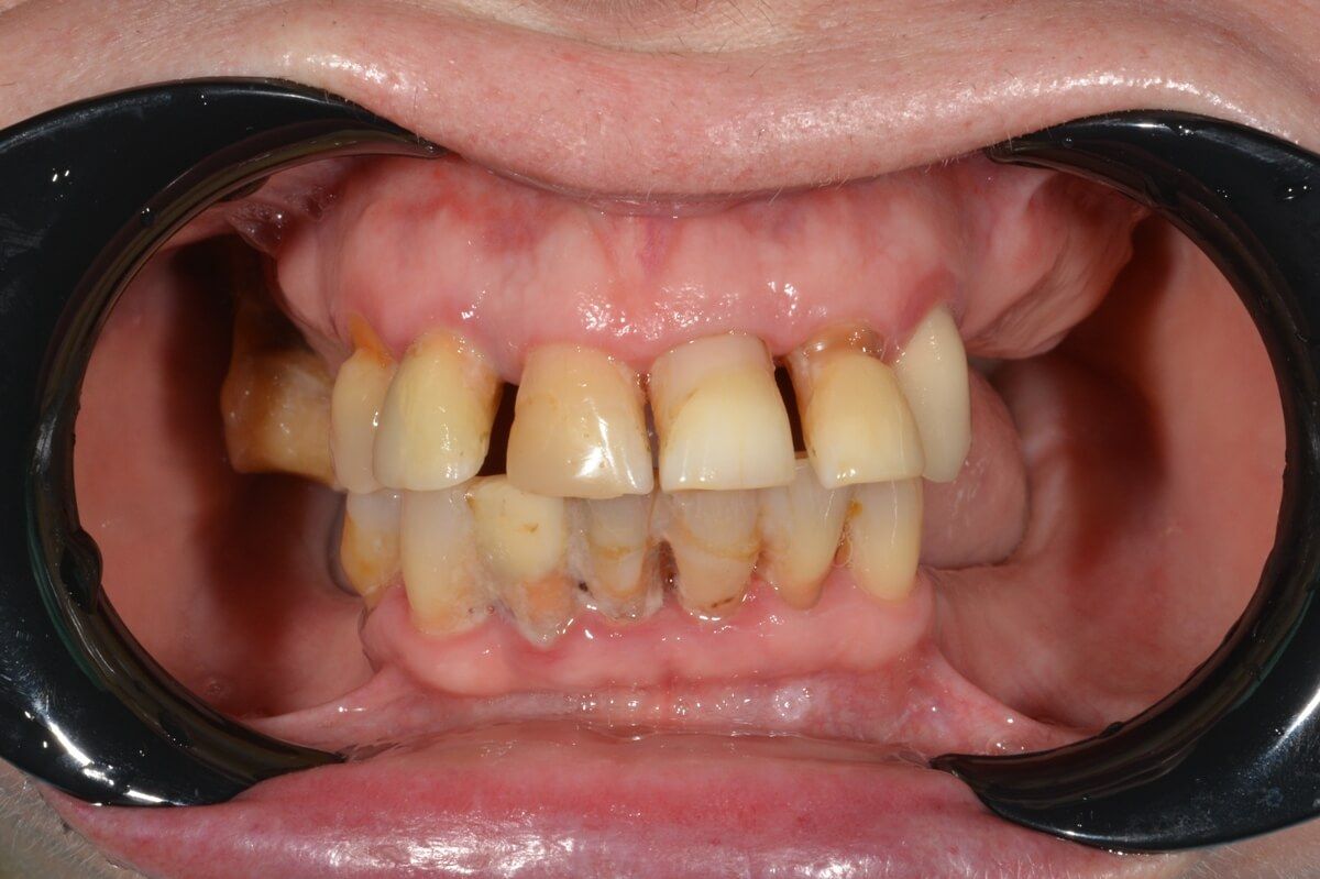 состояние зубов до имплантации all-on-4