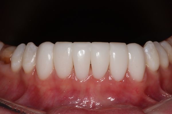 снимок зубов до эстетической реставрации зубов в стоматологии ТоталСтом