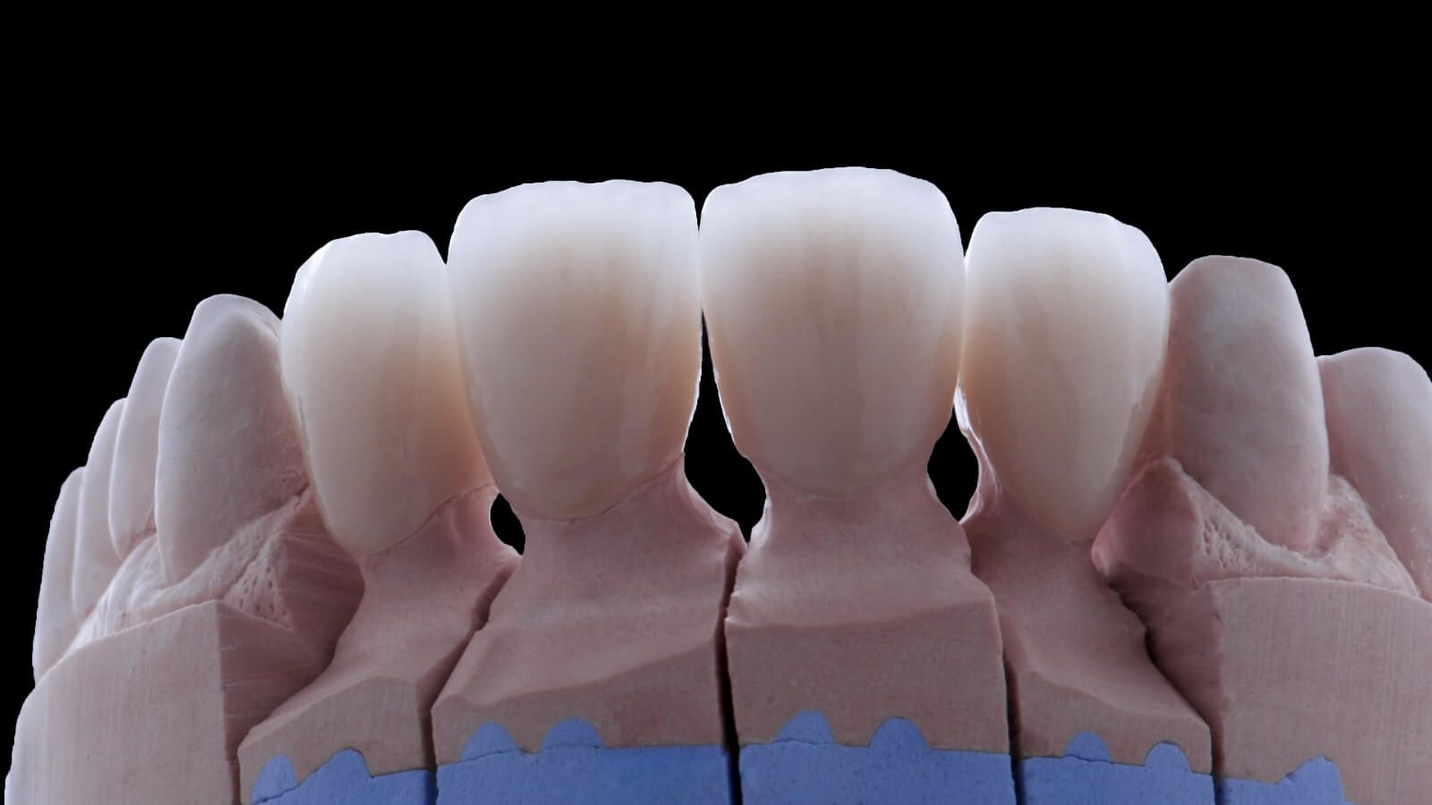 керамические коронки на зубы в клинике ТоталСтом