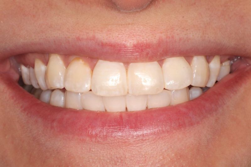 результаты до и после осветления зубов в ТоталСтом