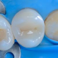 полностью восстановленный зуб после эндодонтического лечения в стоматологии ТоталСтом