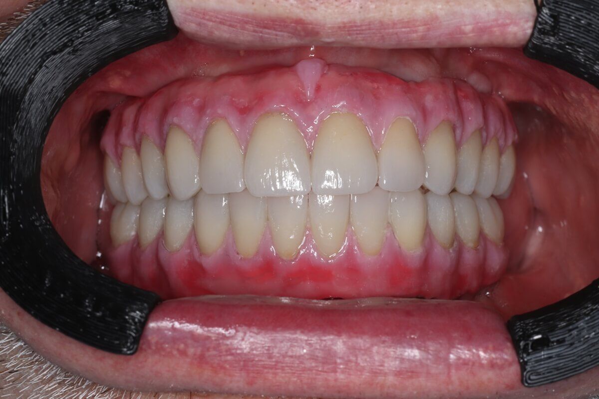 передний зуб после лечения кариеса в стоматологии ТоталСтом