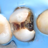 подготовка зуба к лечению каналов