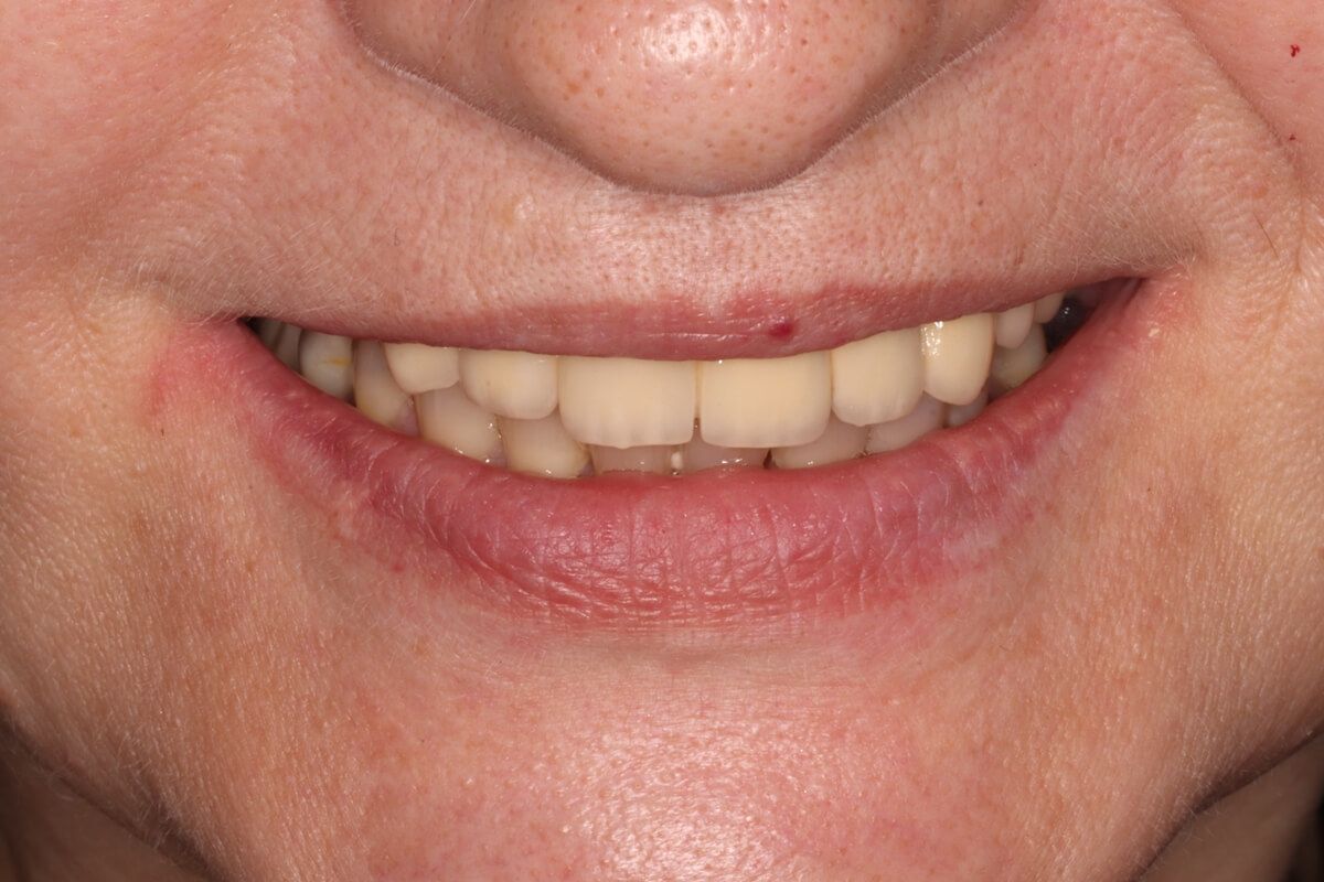 улыбка пациента с восстановленной на 6-ти имплантатах верхней челюстью