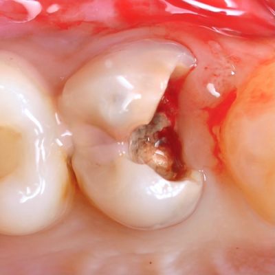 поврежденный зуб до эндодонтического лечения в стоматологии ТоталСтом