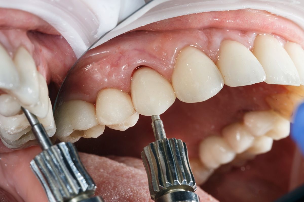 протезирование на имплантах в стоматологии ТоталСтом