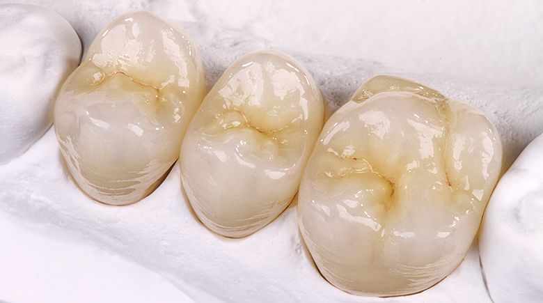 протезирование зубов мостом из диоксида циркония в клинике ТоталСтом