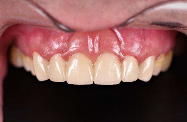 после восстановления передних зубов в клинике ТоталСтом