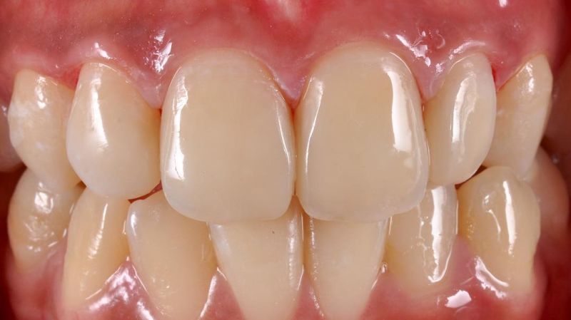передний зуб после лечения и эстетической реставрации в стоматологии ТоталСтом