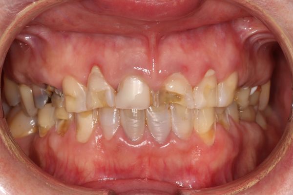 кариозные зубы до лечения 