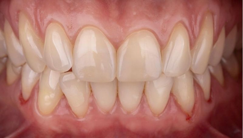 снимок зубов до эстетической реставрации зубов в стоматологии ТоталСтом