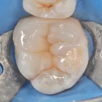 восстановление жевательной поверхности зуба