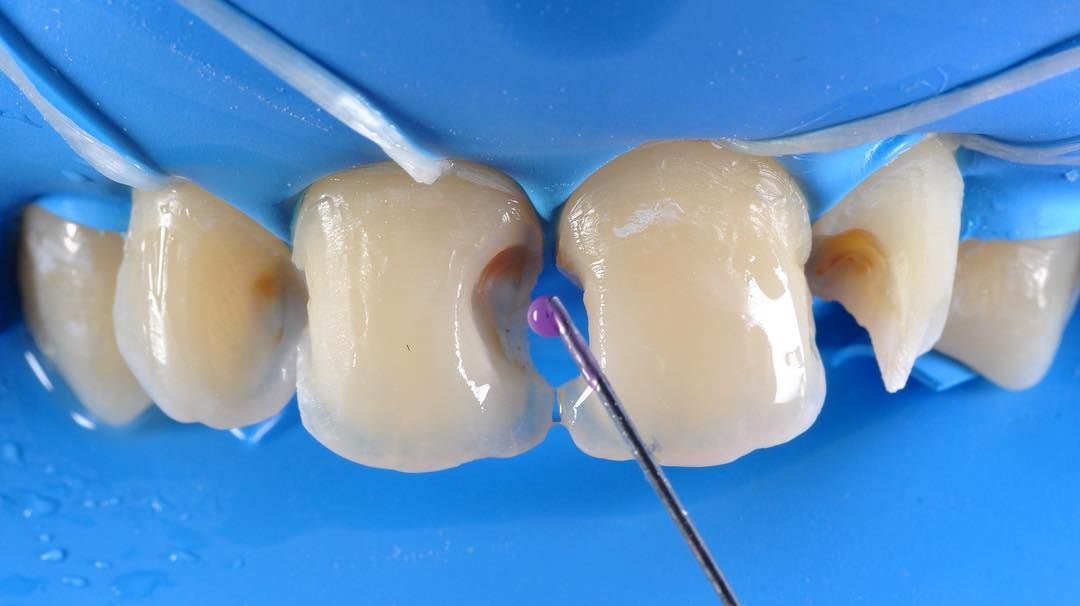 передние зубы после удаления кариозной эмали в стоматологии ТоталСтом