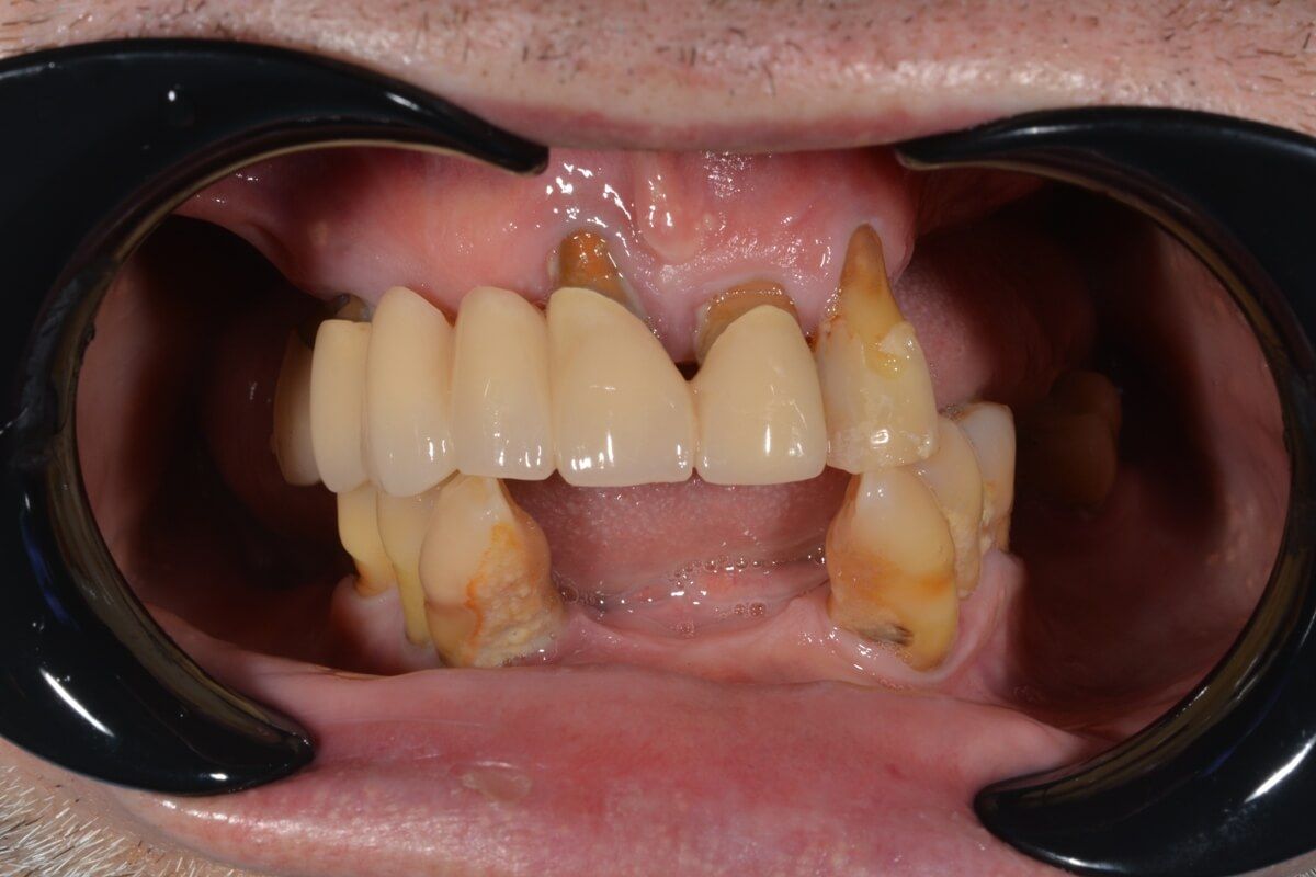 поражение зубов до проведения имплантации в клинике ТоталСтом