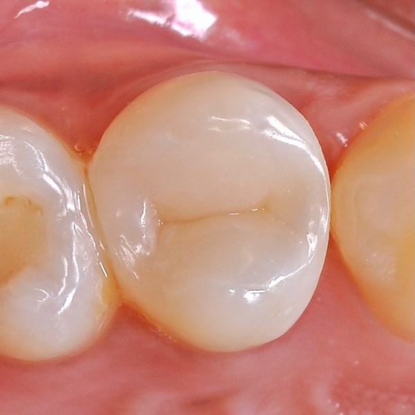 восстановленный зуб после эндодонтического лечения в стоматологии ТоталСтом