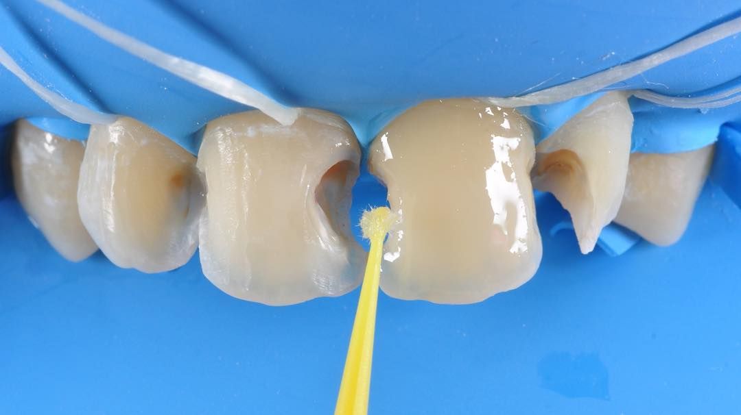 обработанные передние зубы перед внесением пломбировочного материала в стоматологии ТоталСтом