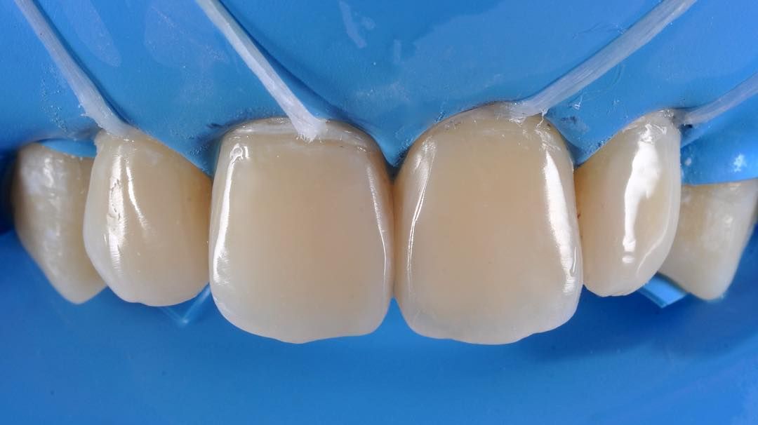передние зубы после эстетической реставрации в стоматологии ТоталСтом
