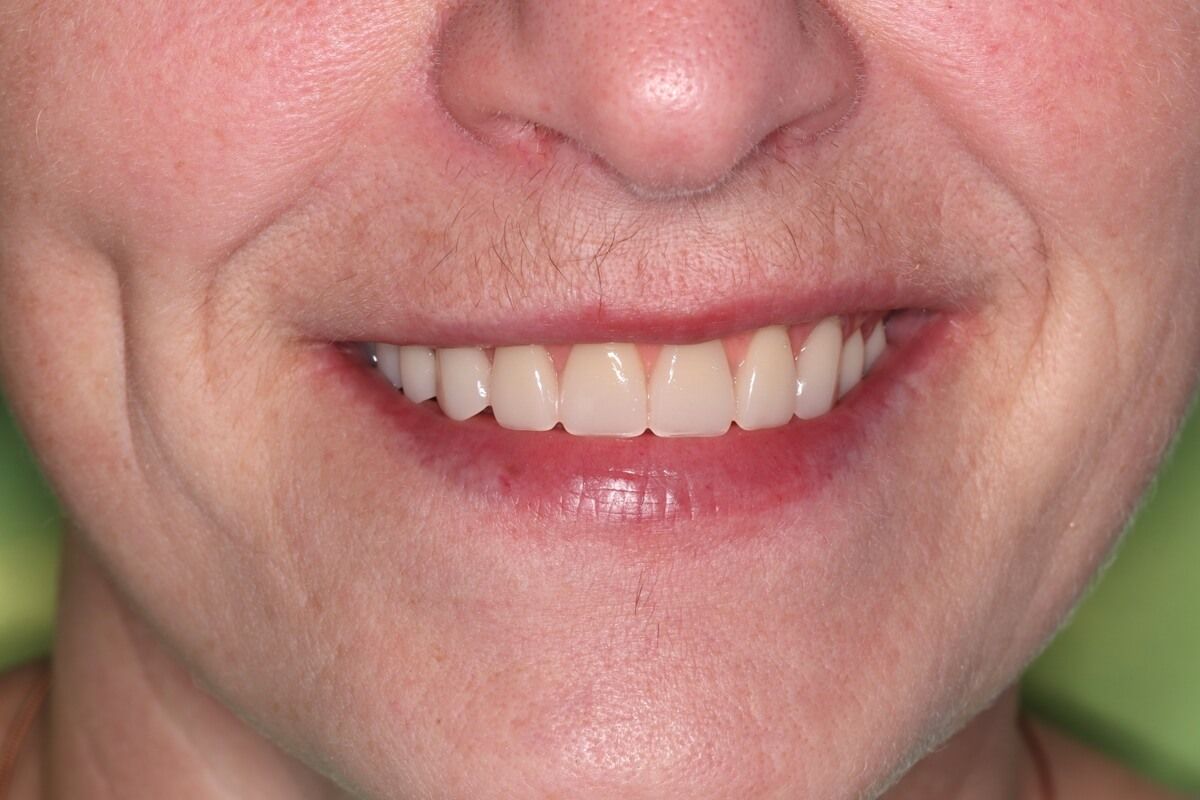 улыбка пациента после реабилитации верхней челюсти на 6 имплантатах