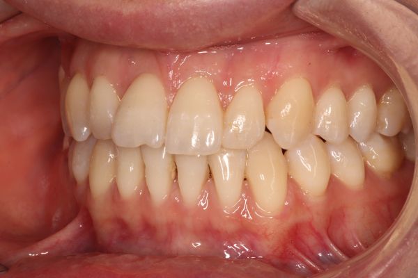 снимок зубов после эстетической реставрации зубов в стоматологии ТоталСтом