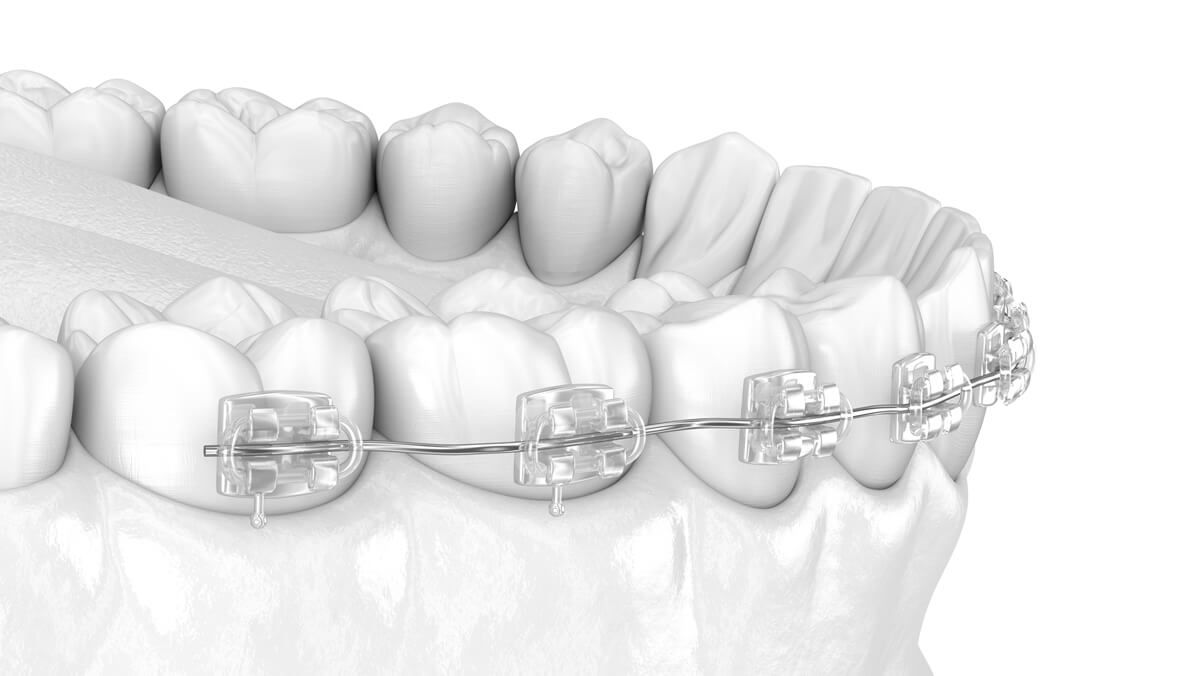 керамические брекеты в стоматологии ТоталСтом
