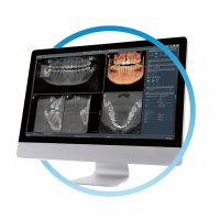 томография зубов перед имплантацией all-on-4