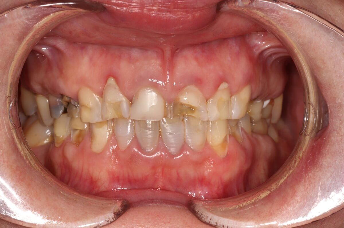 кариозное поражение зубов до протезирования