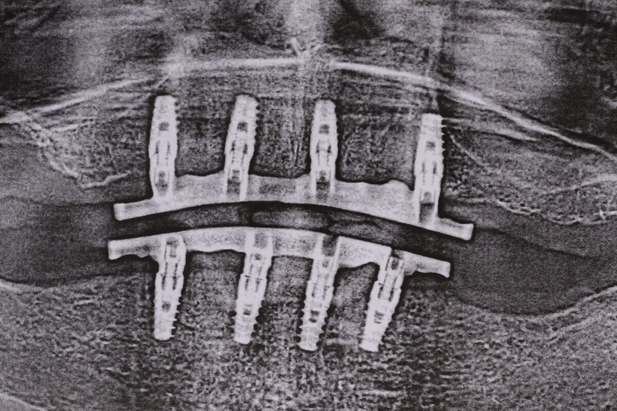 рентген установленных имплантатов