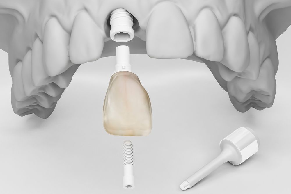 одновременное удаление зуба и установка имплантата в стоматологии ТоталСтом