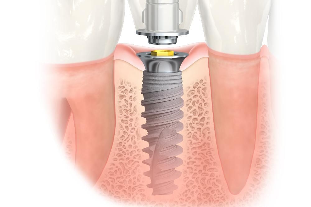 восстановление зубов с помощью имплантации в клинике ТоталСтом