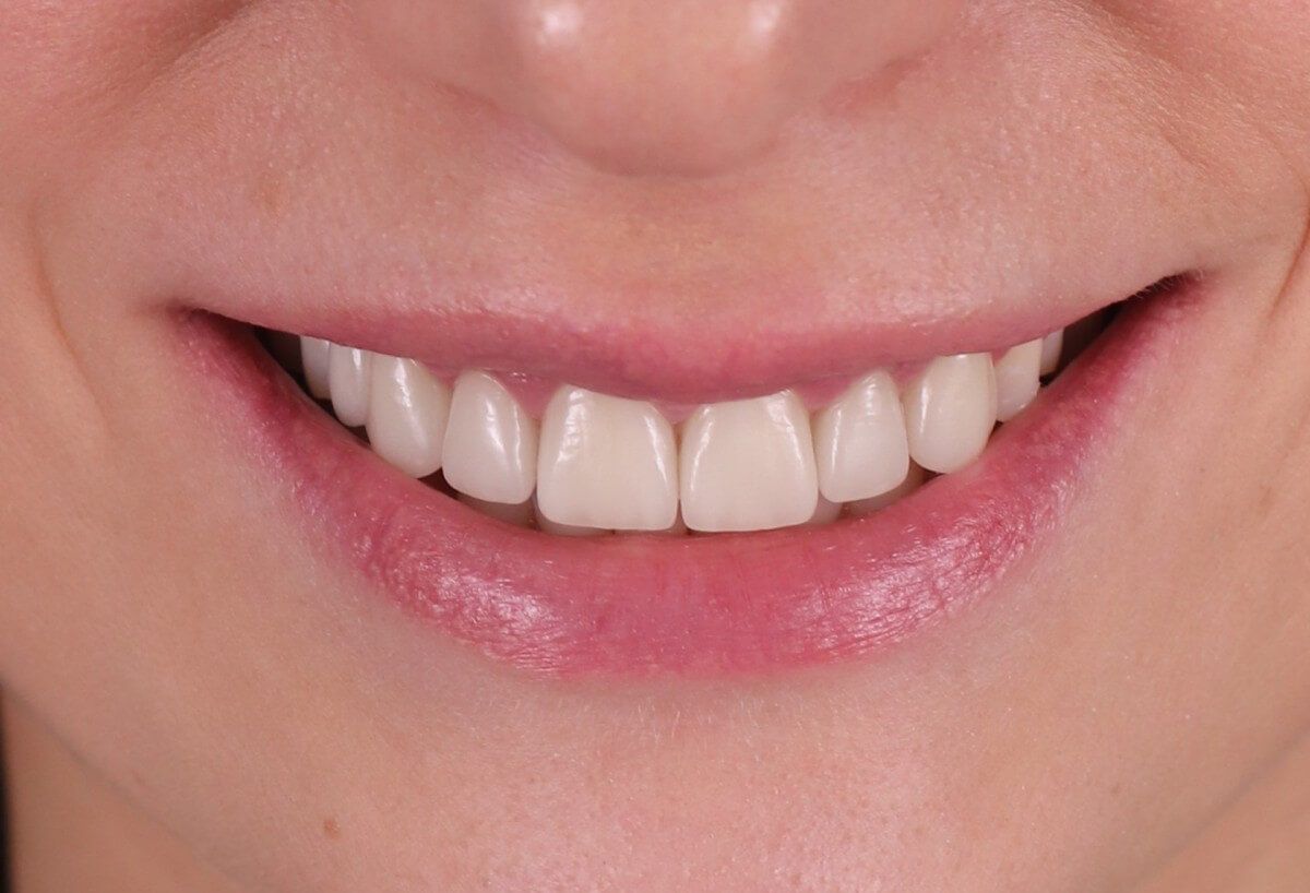 реставрация винирами передних зубов верхней челюсти в ТоталСтом