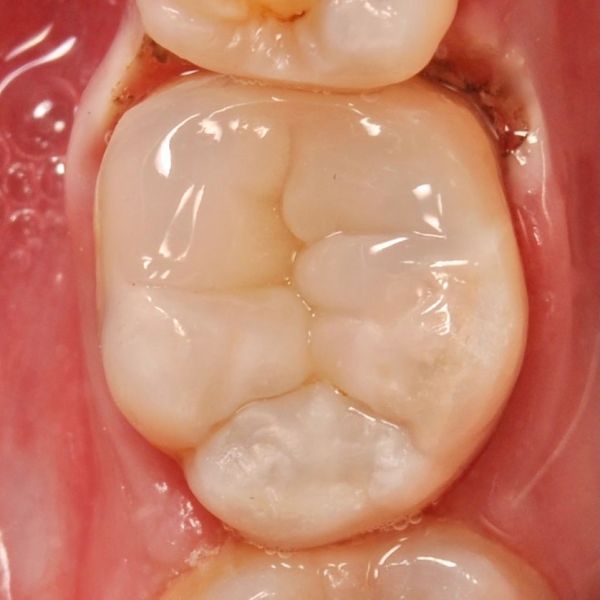 жевательный зуб после лечения каналов в стоматологии ТоталСтом