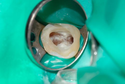 Лечение пульпита и периодонтита в стоматологии ТоталСтом