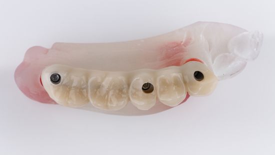 подшитая десна в районе имплантации переднего зуба