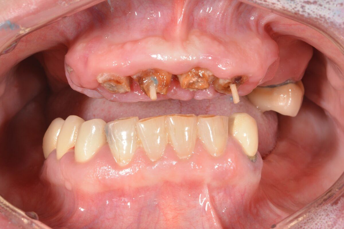 состояние зубов до имплантации в клинике ТоталСтом