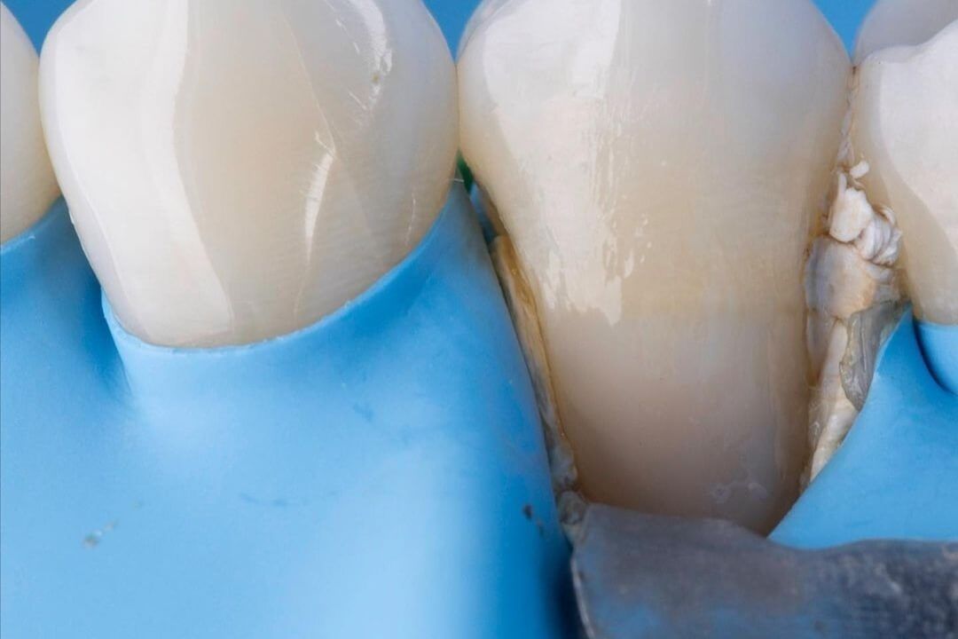 после лечения клиновидного дефекта в стоматологии ТоталСтом