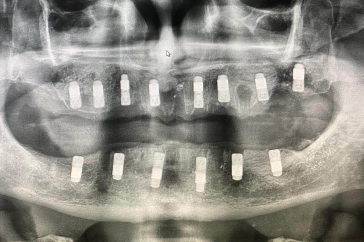Рентген обоих челюстей с установленными трабекулярными имплантатами